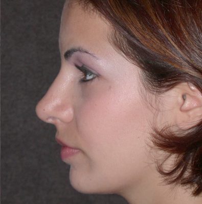 Rhinoplasty before and after, case 08, view 4 (after)