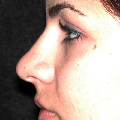 Rhinoplasty before and after, case 08, view 4 (before)