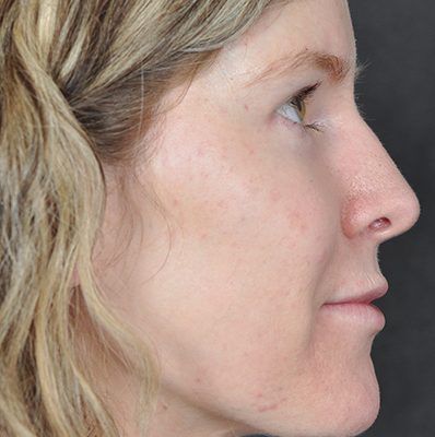 Rhinoplasty before and after, case 09, view 3 (after)