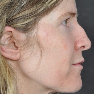 Rhinoplasty before and after, case 09, view 3 (before)