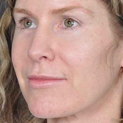 Rhinoplasty before and after, case 09, view 4 (after)