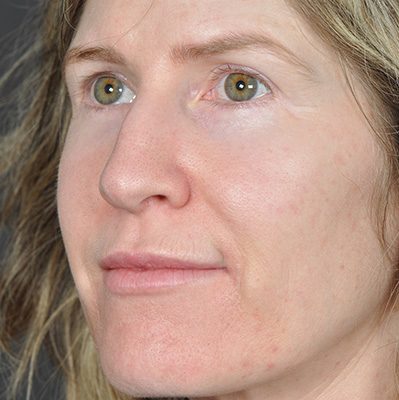 Rhinoplasty before and after, case 09, view 4 (before)