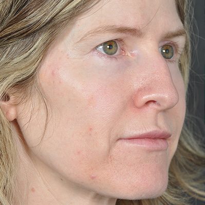 Rhinoplasty before and after, case 09, view 5 (before)