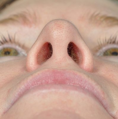 Rhinoplasty before and after, case 09, view 6 (after)