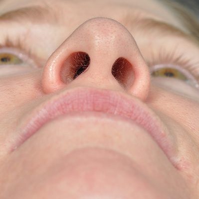 Rhinoplasty before and after, case 09, view 6 (before)