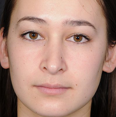 Rhinoplasty after, case 10