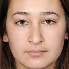 Rhinoplasty before and after, case 10 (before)