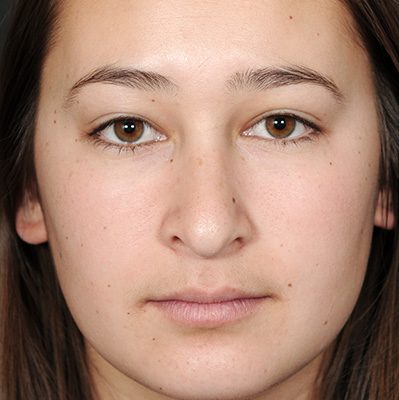 Rhinoplasty before, case 10