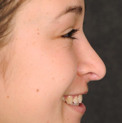 Rhinoplasty before and after, case 10, view 3 (after)