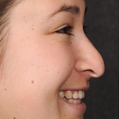 Rhinoplasty before and after, case 10, view 3 (before)