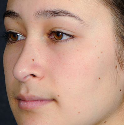 Rhinoplasty before and after, case 10, view 4 (after)