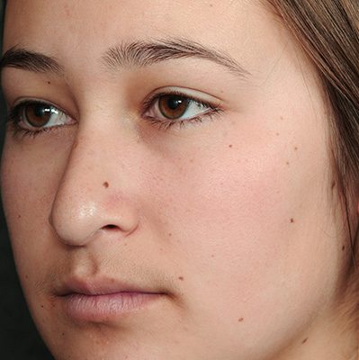 Rhinoplasty before and after, case 10, view 4 (before)