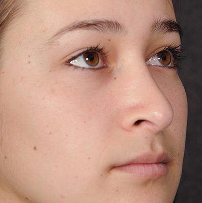 Rhinoplasty before and after, case 10, view 5 (after)