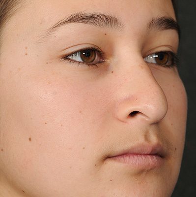 Rhinoplasty before and after, case 10, view 5 (before)