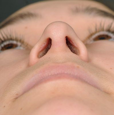 Rhinoplasty before and after, case 10, view 6 (after)