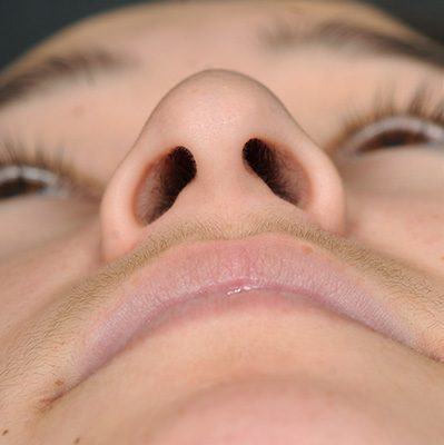 Rhinoplasty before and after, case 10, view 6 (before)