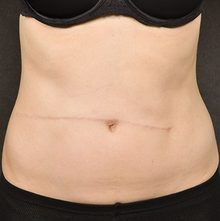 Scar Revision before and after, case 01 (after)