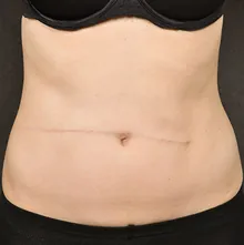Scar Revision, case 01, after