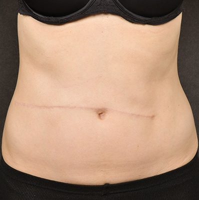 Scar Revision after, case 01