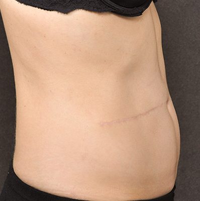 Scar Revision before and after, case 01, view 3 (after)