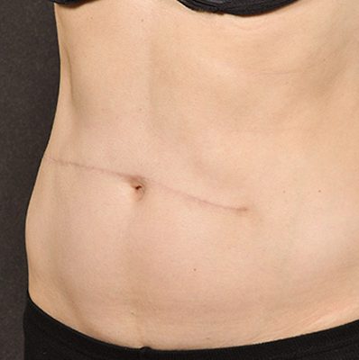 Scar Revision before and after, case 01, view 4 (after)