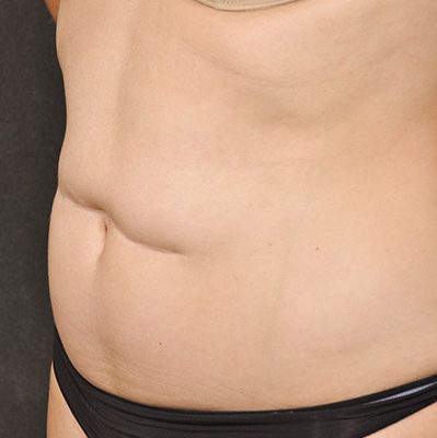 Scar Revision before and after, case 01, view 4 (before)