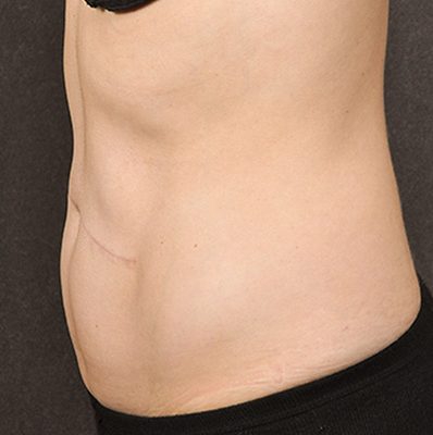 Scar Revision before and after, case 01, view 5 (after)