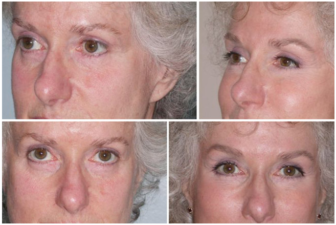 Dr. Kao - Contour Eyelift Before & After Photos