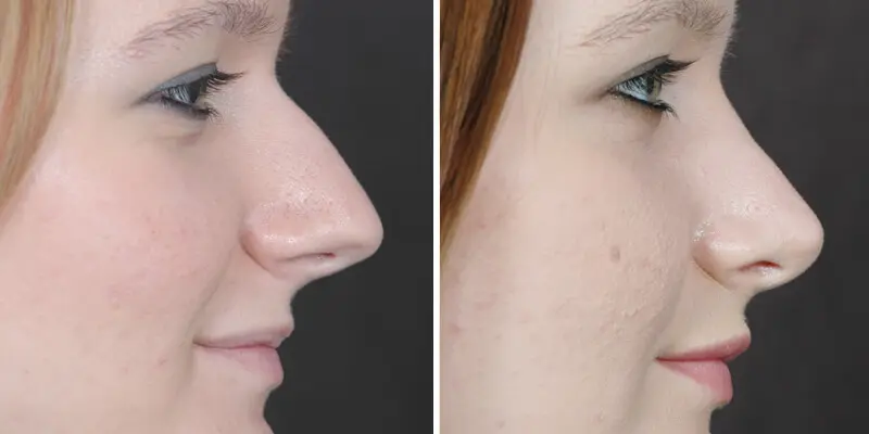 Rhinoplasty