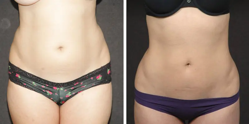 Liposuction