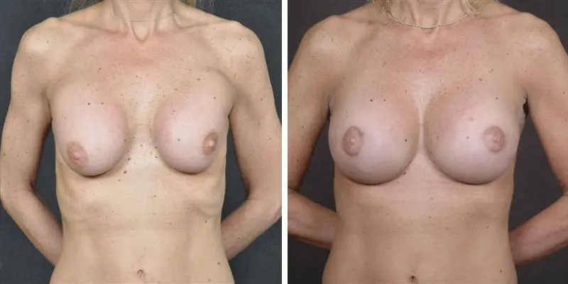 Breast implant revision before and after result by Dr. Chia Chi Kao