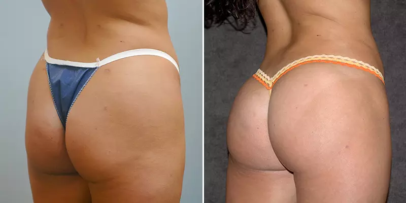 Before and after Brazilian Butt Lift side-by-side comparison with improved body contour
