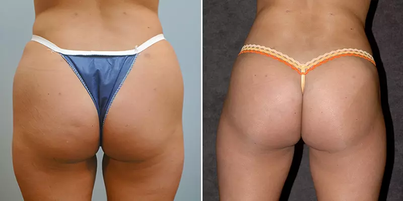 Before and after Brazilian Butt Lift side-by-side comparison with improved body contour