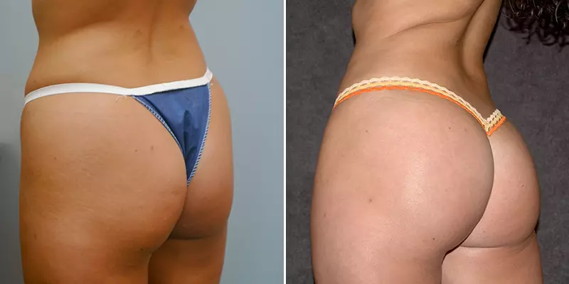 Before and after Brazilian Butt Lift side-by-side comparison with improved body contour