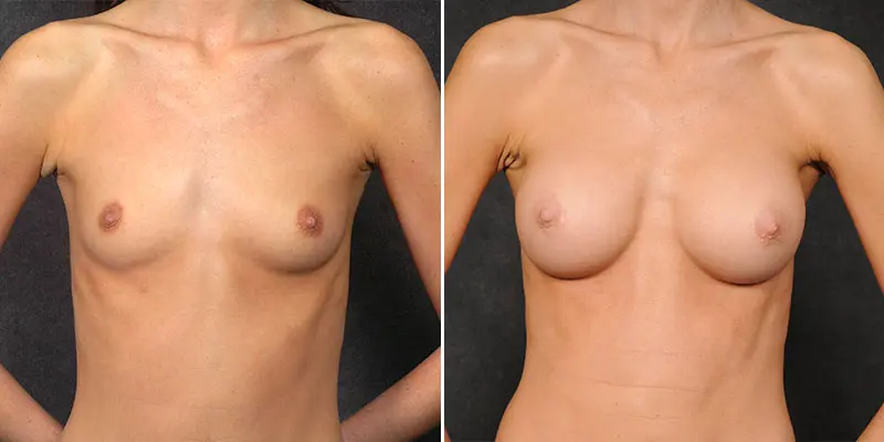 Breast Augmentation