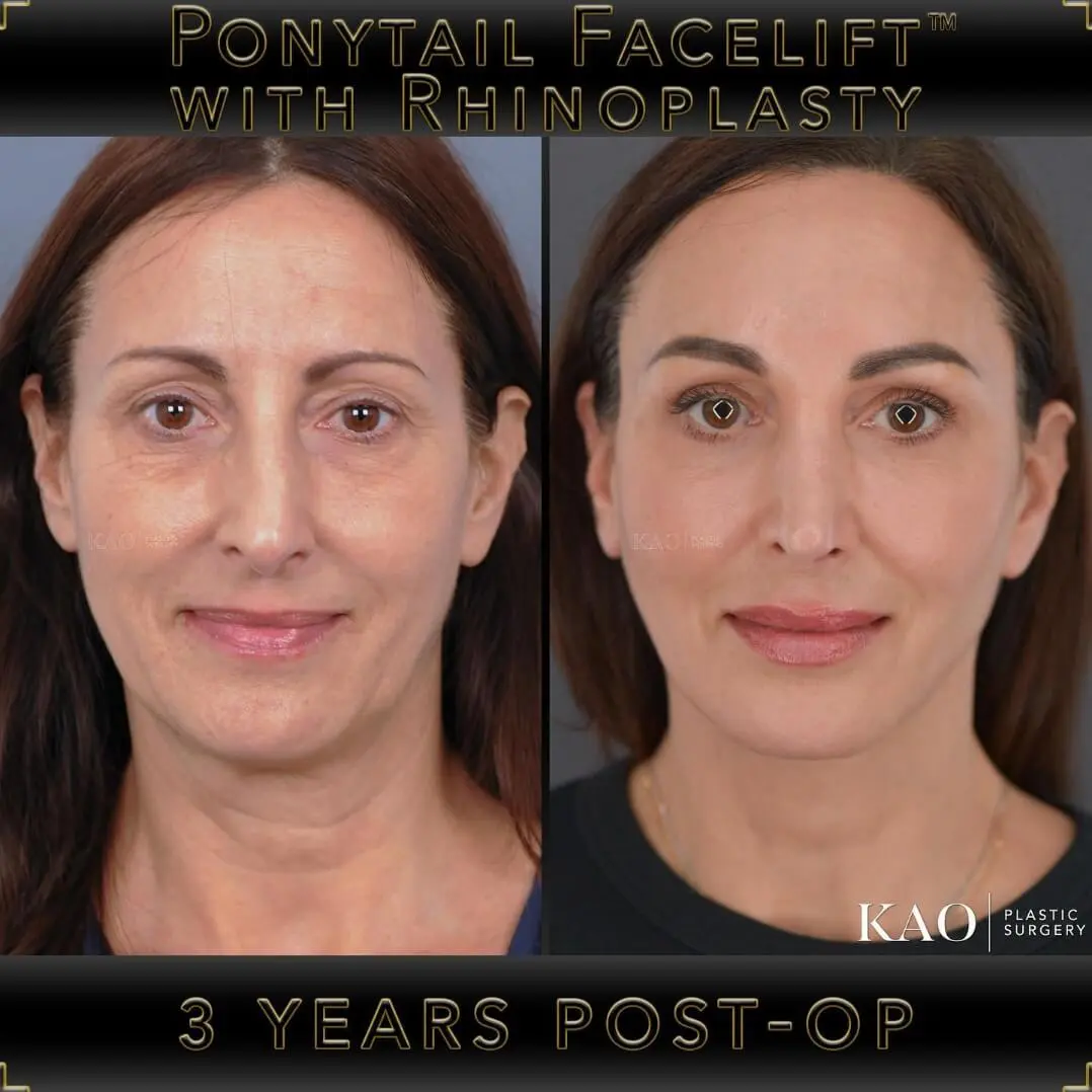 Ponytail Lift® and Ponytail Facelift™ in Los Angeles