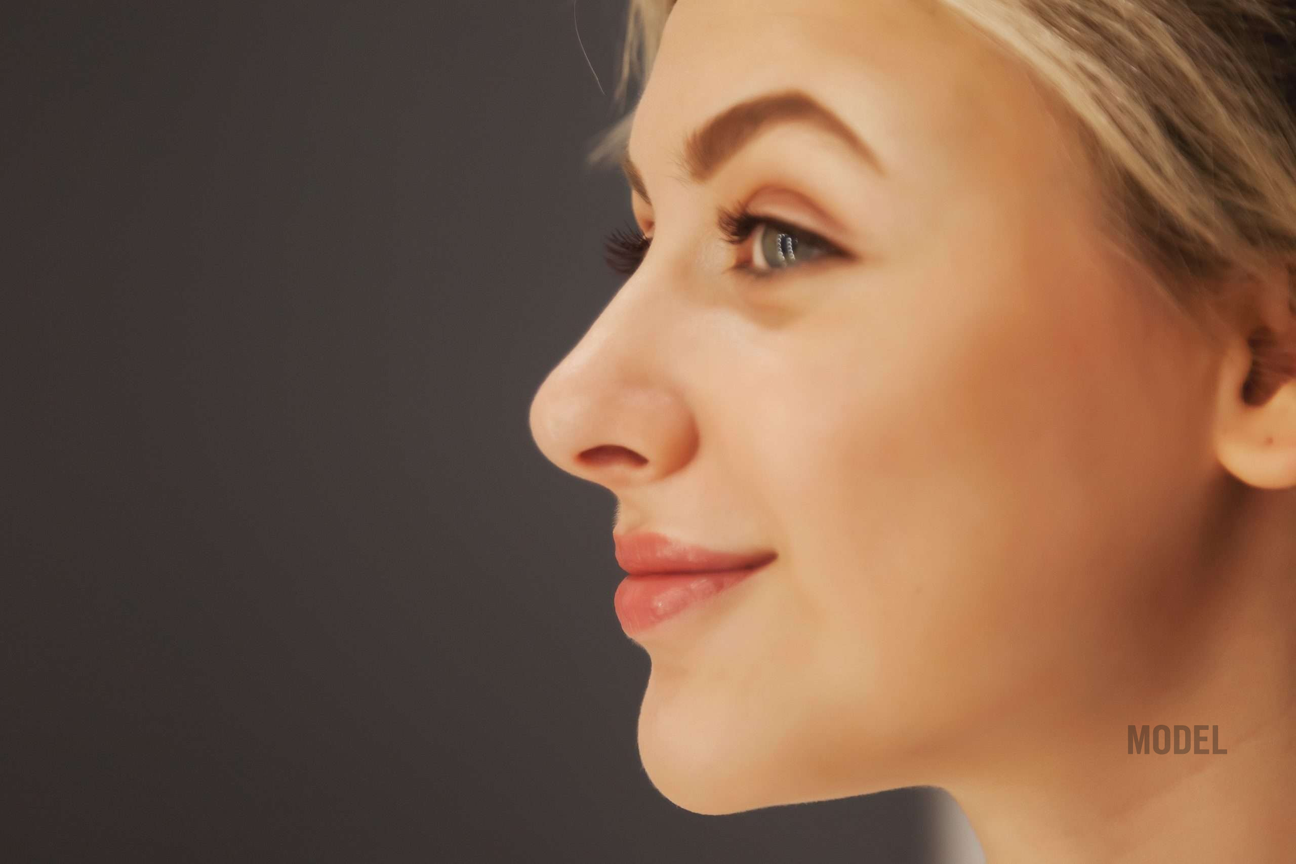 Natural-looking rhinoplasty result with balanced facial proportions