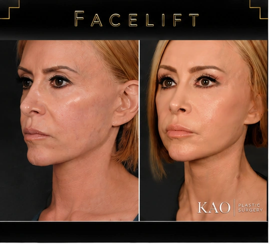 facelift before after los angeles 01