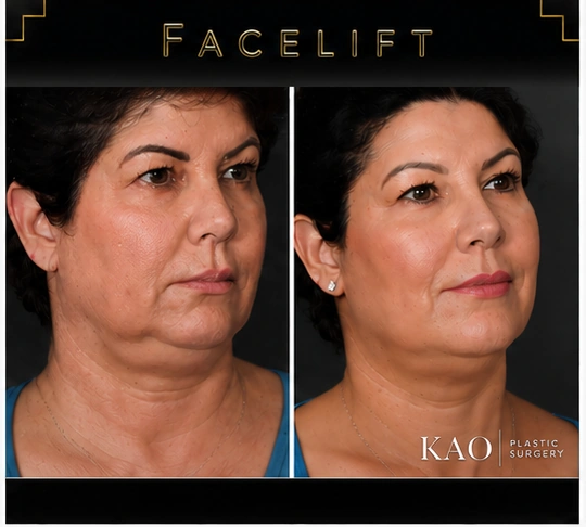 facelift before after los angeles 02