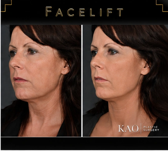 facelift before after los angeles 03
