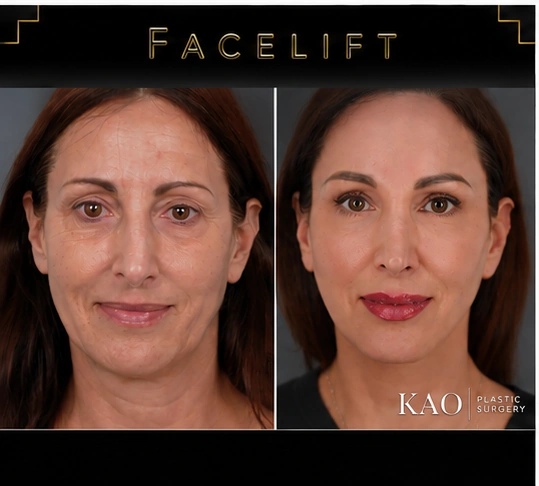 facelift before after los angeles 04