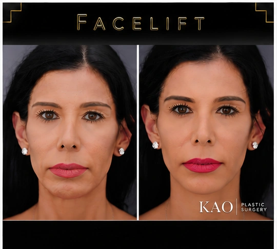 facelift before after los angeles 05